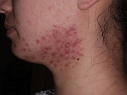 スピロノラクトン治療前