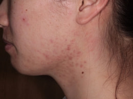 スピロノラクトン治療中