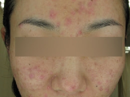 スピロノラクトン治療前