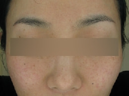 スピロノラクトン内服6ヶ月目