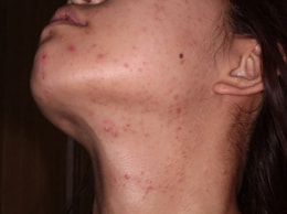 スピロノラクトン治療前