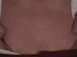 スピロノラクトン治療中