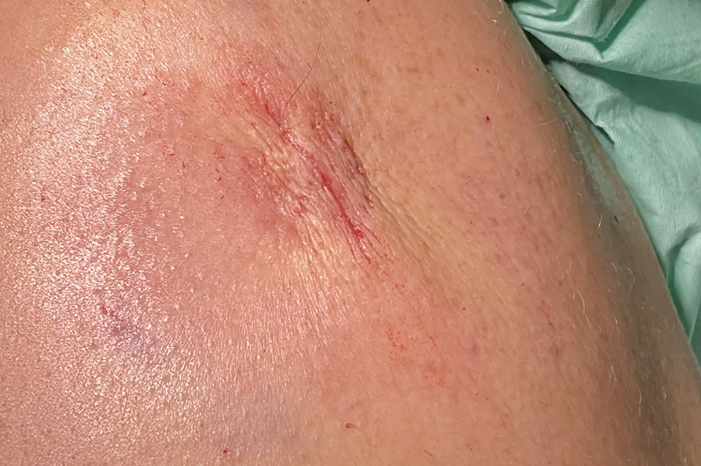 脂肪腫 手術後1週間