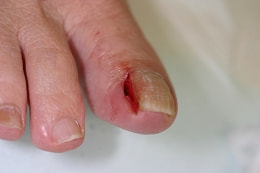 フェノール法 部分抜爪