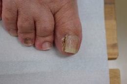 フェノール法 手術後1ヶ月