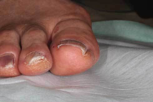 フェノール法 手術前