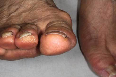 フェノール法 手術後2ヶ月