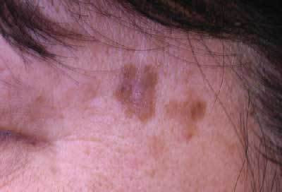 老人性イボ 治療前