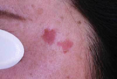 老人性イボ 治療直後