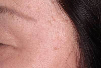 老人性イボ 治療半年後