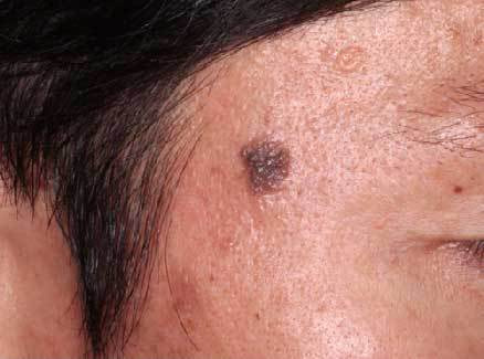 老人性イボ 治療前