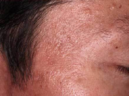 老人性イボ 治療後1ヶ月