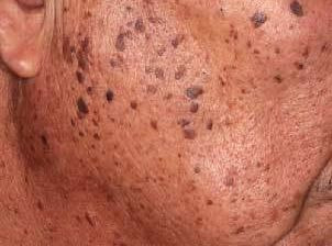 老人性イボ 治療前