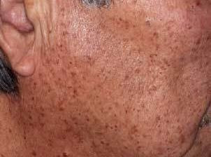 老人性イボ 治療後4ヶ月