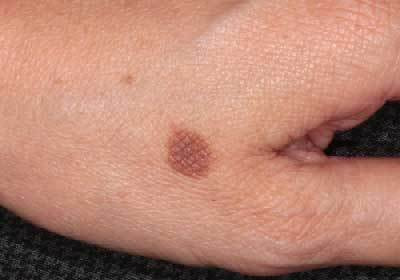 老人性イボ 治療前