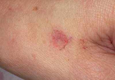 老人性イボ 治療直後