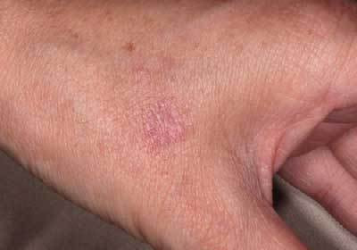 老人性イボ 治療後1ヶ月