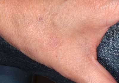 老人性イボ 治療後5ヶ月