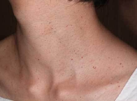 アクロコルドン 治療前