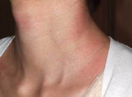 アクロコルドン 治療1ヶ月半後