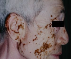 尋常性白斑の脱色療法 治療前