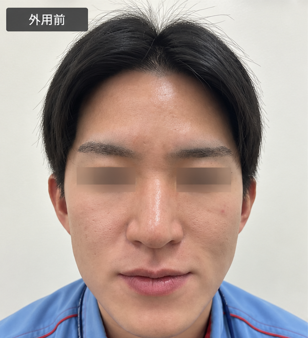 尋常性白斑の脱色療法　治療前