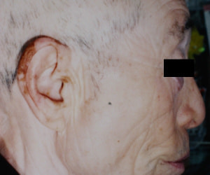 尋常性白斑の脱色療法 治療後