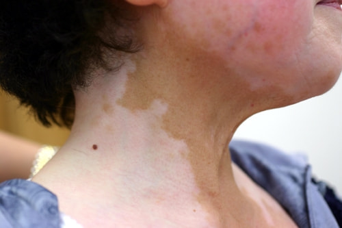 尋常性白斑の脱色療法 治療前