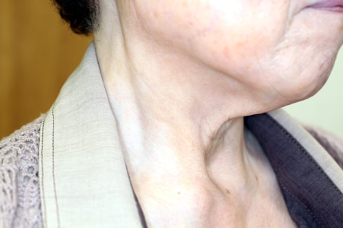 尋常性白斑の脱色療法 治療後