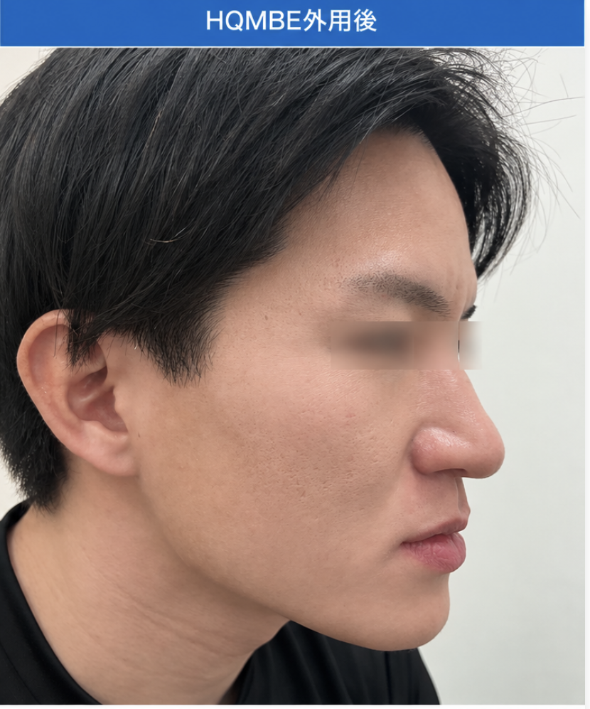尋常性白斑の脱色療法　治療後