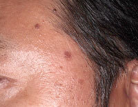 老人性イボ(脂漏性角化症)