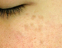 後天性真皮メラノサイトーシス(ADM)