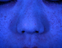 ソバカス(雀卵斑)