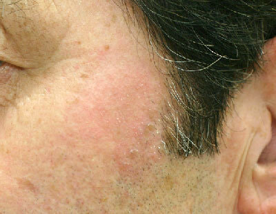 治療後1ヶ月の老人性色素斑