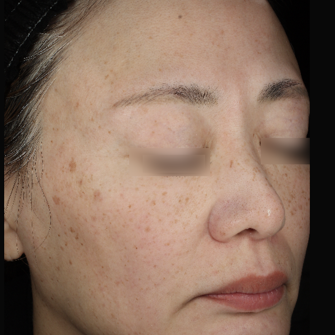 ピコトーニング治療前