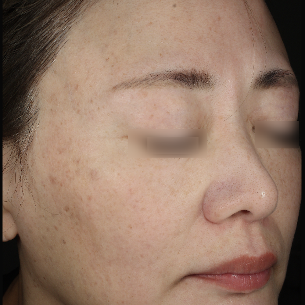 ピコトーニング2回治療後