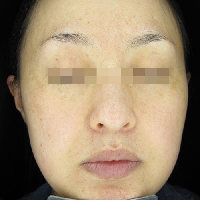 ピコトーニング4回治療後