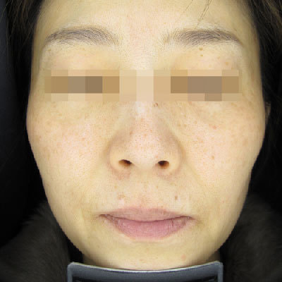 ピコトーニング4回治療後