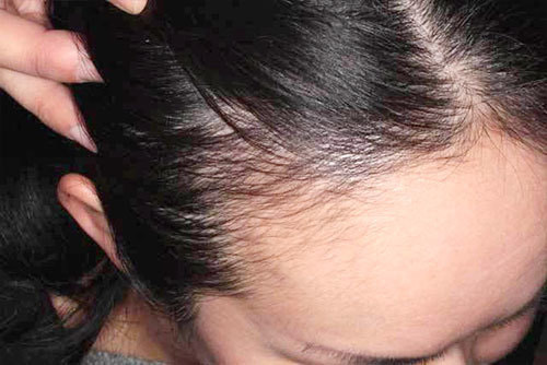 ミノキシジルアルファローション外用使用1ヶ月後