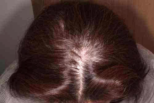 ミノキシジルアルファローション外用使用9ヶ月後