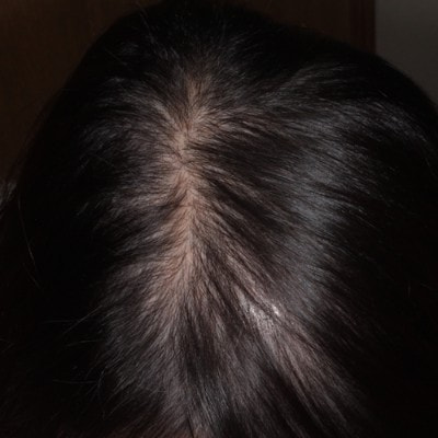 ミノキシジル内服2ヶ月