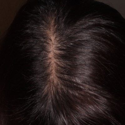 ミノキシジル内服5ヶ月