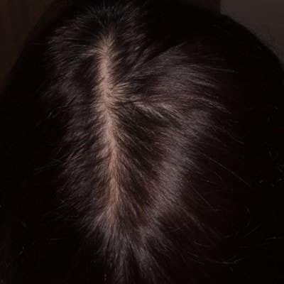 ミノキシジル内服11ヶ月