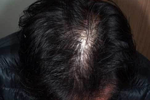 5ヶ月内服 フィナステリド・ミノキシジルタブレットを5ヶ月内服