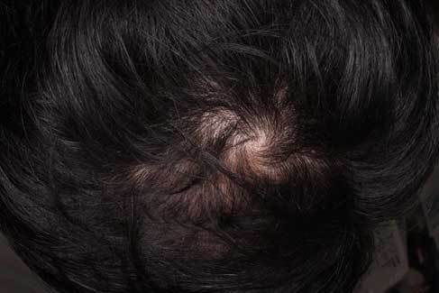 4ヶ月内服 フィナステリド・ミノキシジルタブレットを4ヶ月内服