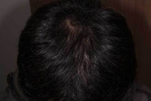 3ヶ月内服 フィナステリド・ミノキシジルタブレットを3ヶ月内服