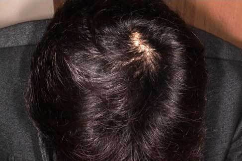 5ヶ月内服 フィナステリド・ミノキシジルタブレットを5ヶ月内服 料金