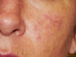 毛細血管拡張症(赤ら顔)の治療前