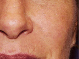 毛細血管拡張症(赤ら顔)の治療後