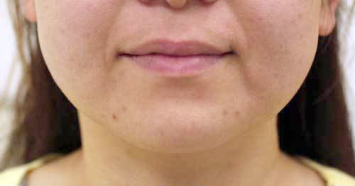 治療前・両頬で6本使用しています。